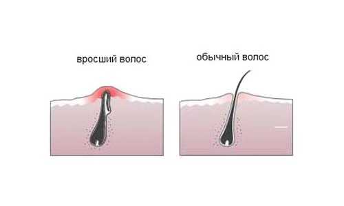 Удаление вросших волос на теле в сети клиник ниармедик