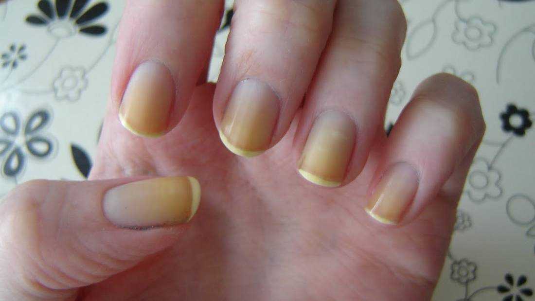 Желтые ногти: у женщин и мужчин, причины, после лака, как избавиться от желтизны, как отбелить желтое пятно под ногтем