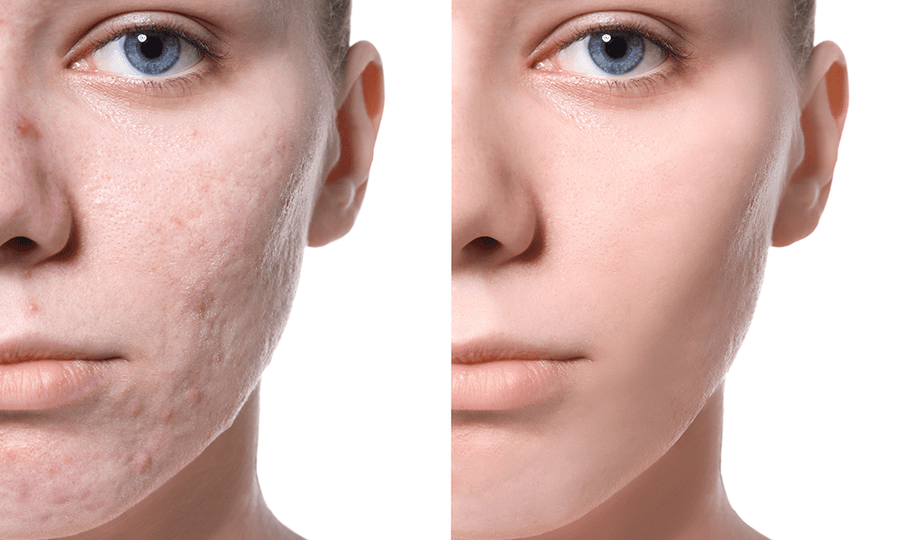 Жирная кожа лица: правильный ежедневный уход | блог expert clinics