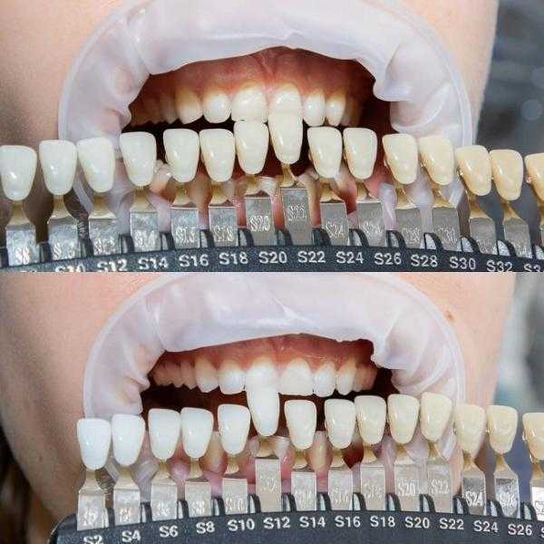 Красивые зубы - как сделать улыбку неотразимой - smile4you.ru