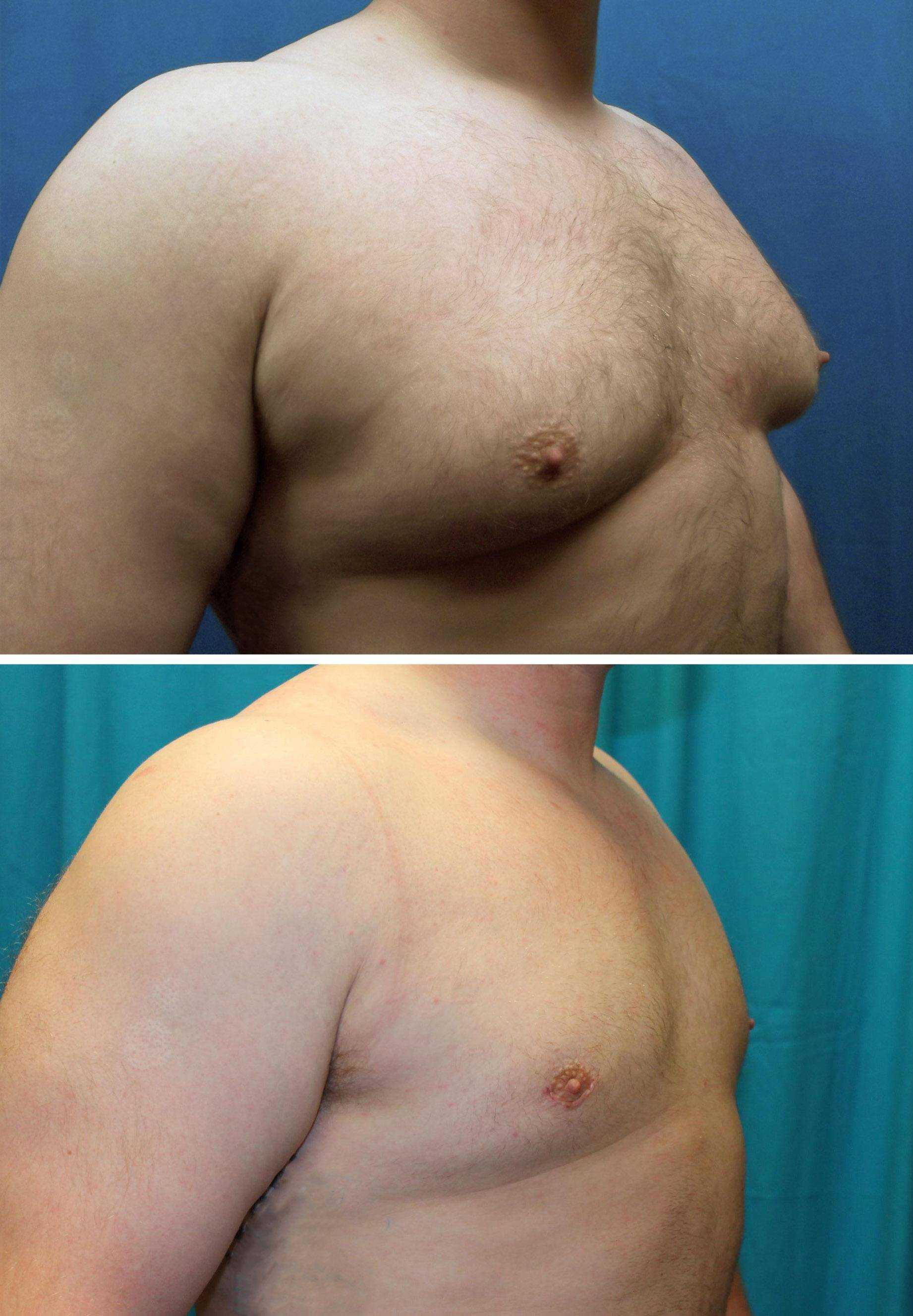 удаления жира из груди у мужчин фото 53