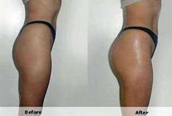 Hydrogel buttock injections atlanta вњ"Hydrogel Butt Injecti