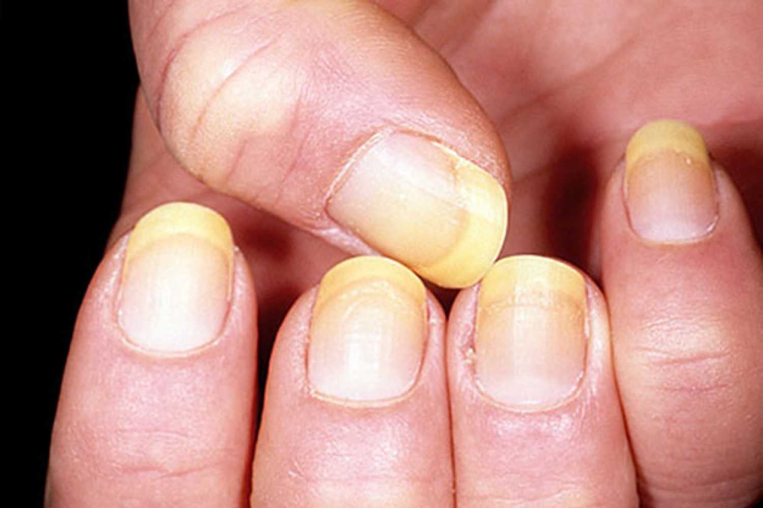 Желтые ногти: причины и лечение :: syl.ru