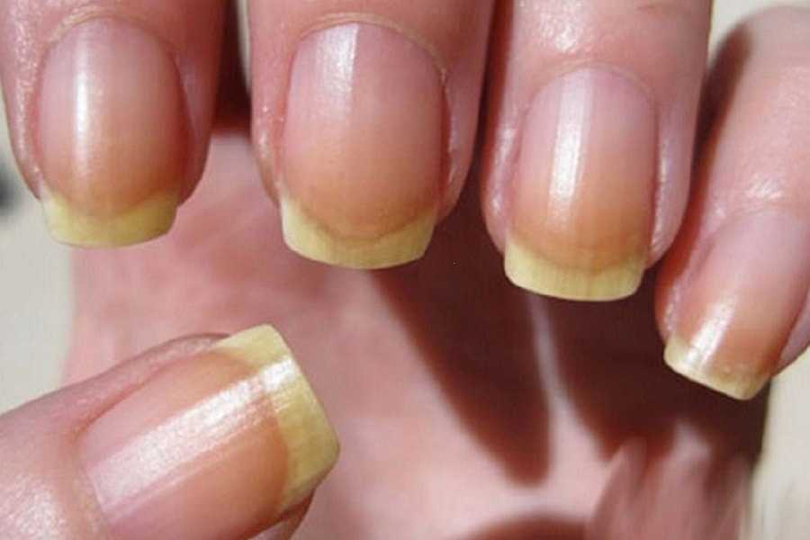 7 простых способов отбелить желтые ногти в домашних условиях