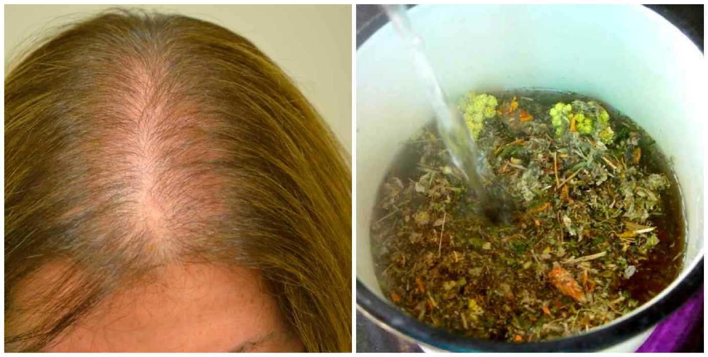 Травы от выпадения волос у женщин и мужчин: отзывы, эффективные рецепты от облысения (с корнем лопуха, крапивой и другие)