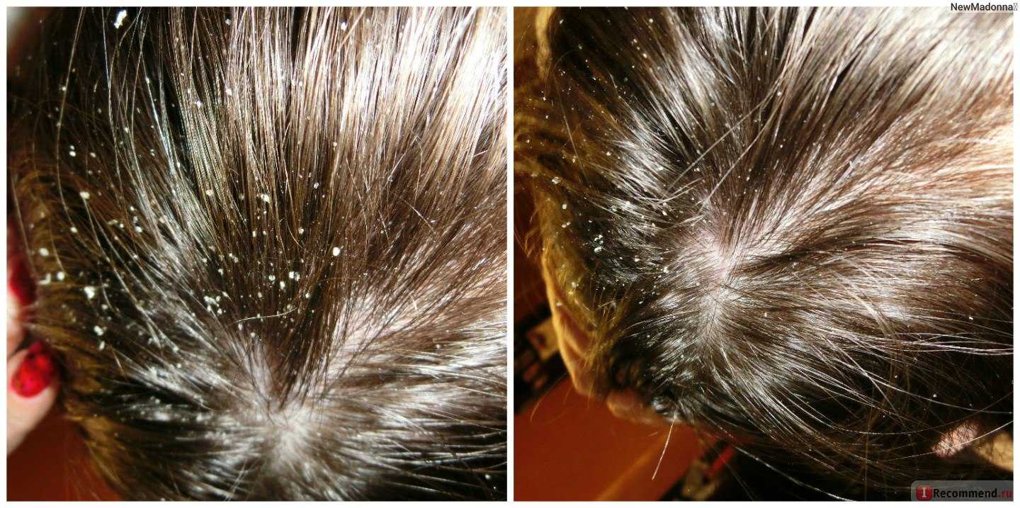Сухая кожа головы и перхоть - клиника «доктор волос»