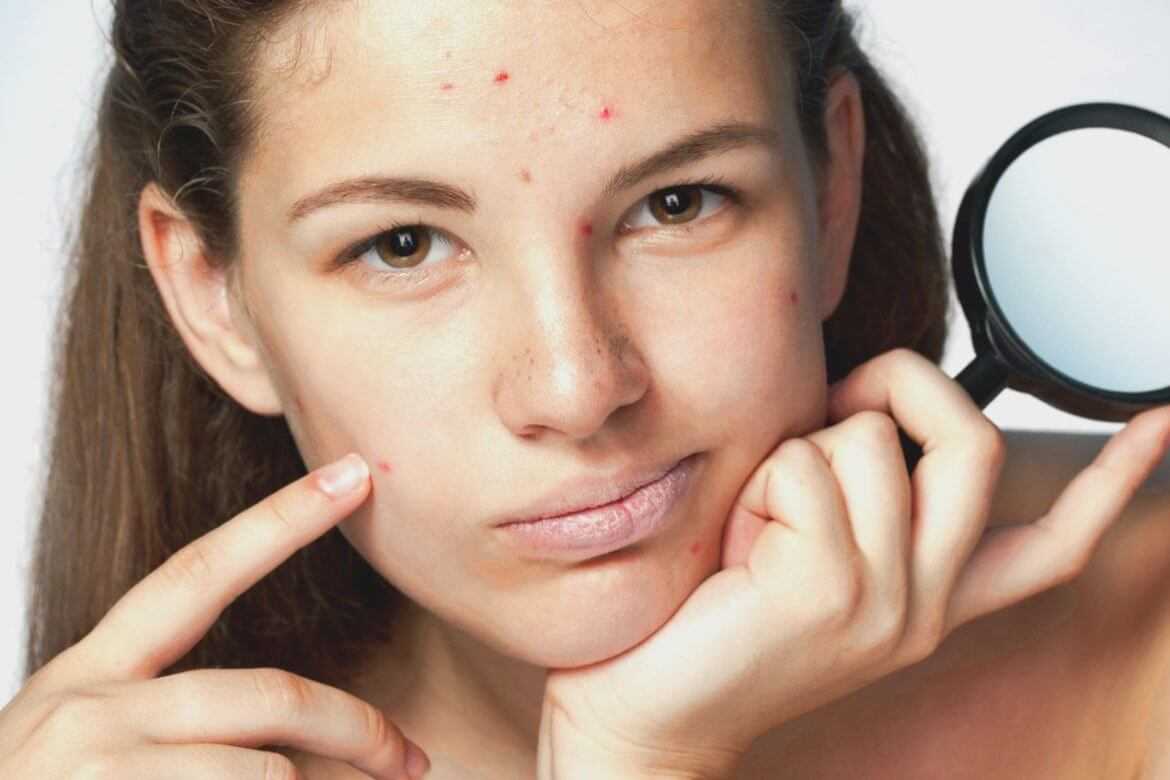 Как избавиться от рубцов постакне, быстро убрать следы от пятен на лице и навсегда вылечить шрамы с помощью косметолога: что хорошо помогает для лечения покраснений – эффективные средства и способы