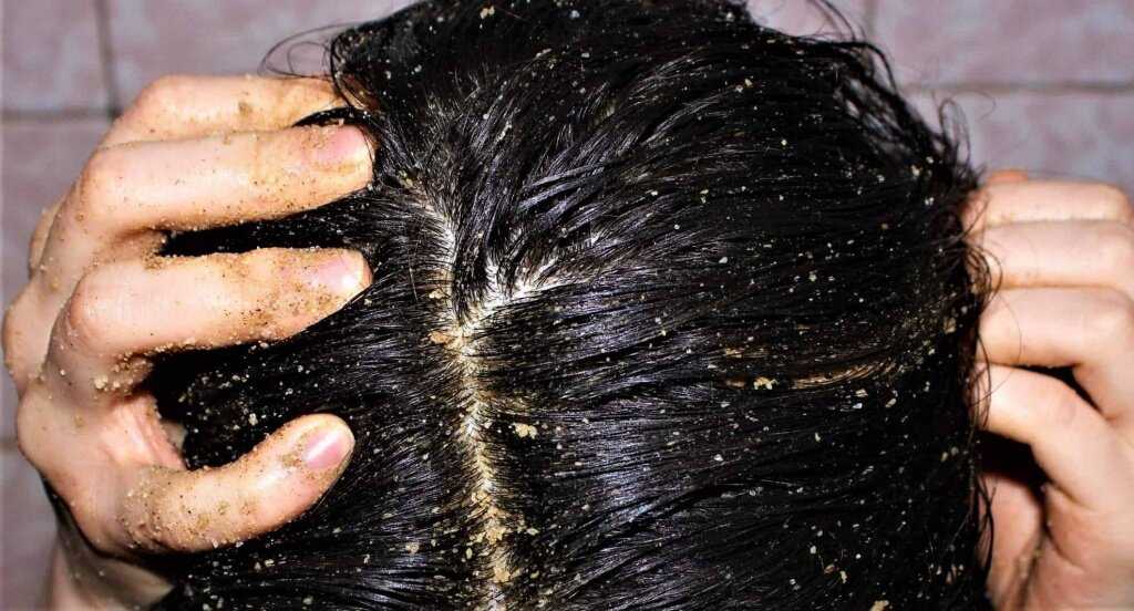 Защищают ли волосы кожу головы