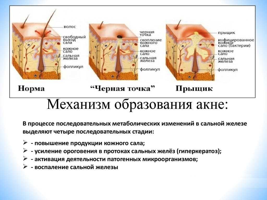 Виды прыщей на теле у женщины схема и описание