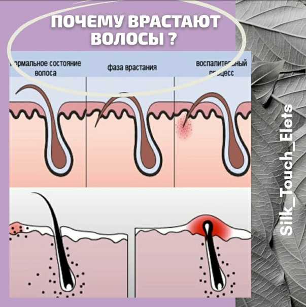 Процедура лазерной эпиляции - грозит ли она чем-то здоровью женщины? мифы и реальность о лазерной эпиляции.