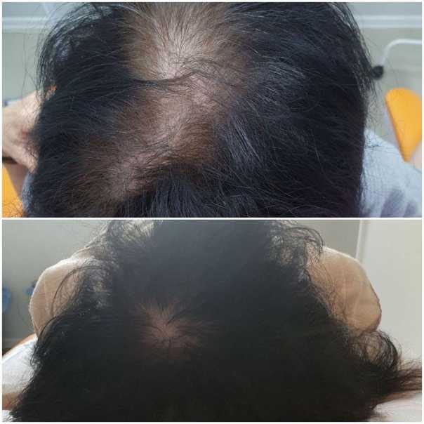 После ковида выпадают волосы что делать. Трихология выпадение волос. Мезотерапия волос до и после. Выпадение волос до и после.