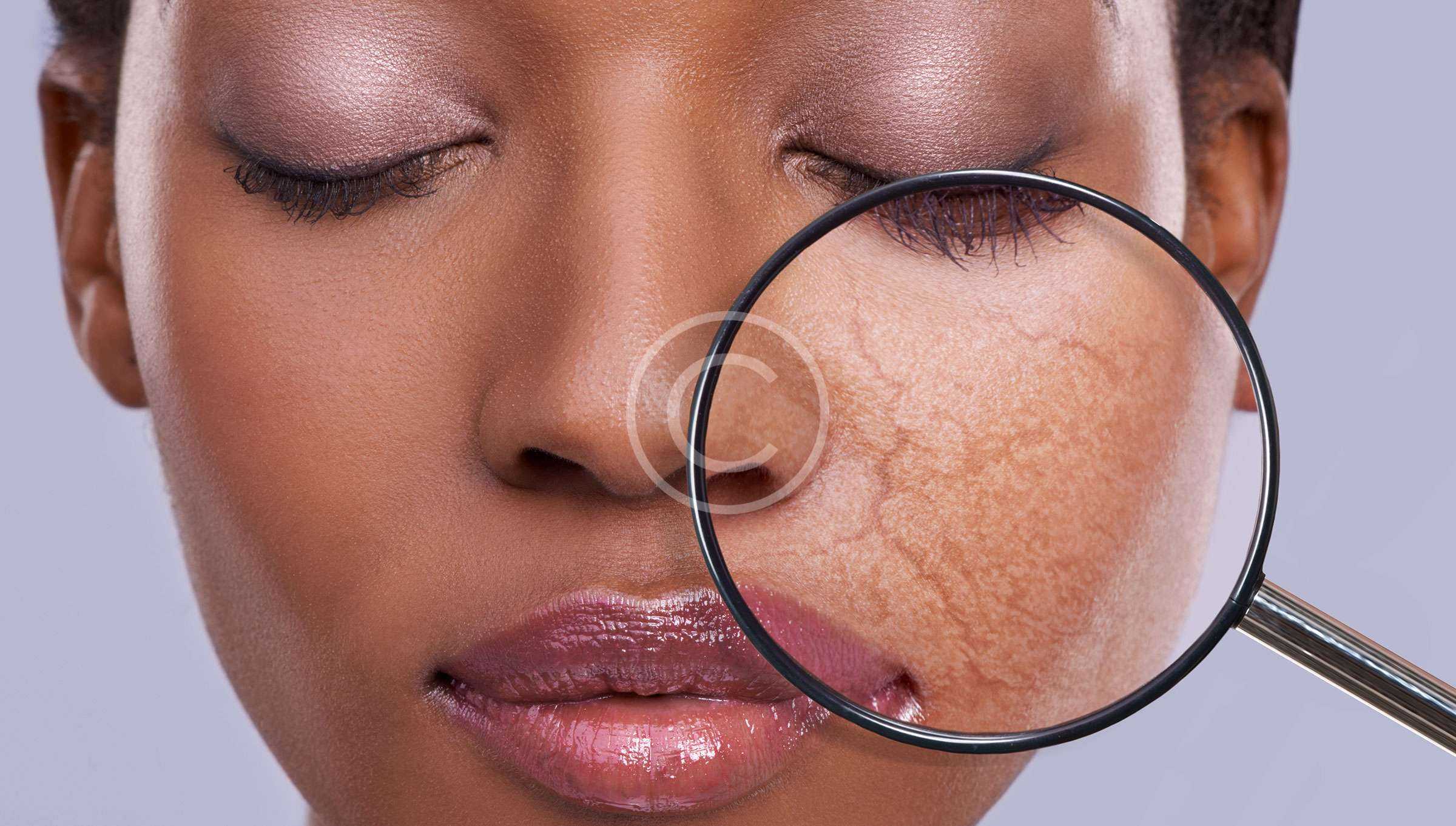 Дряблость кожи. причины, симптомы и лечение дряблости кожи