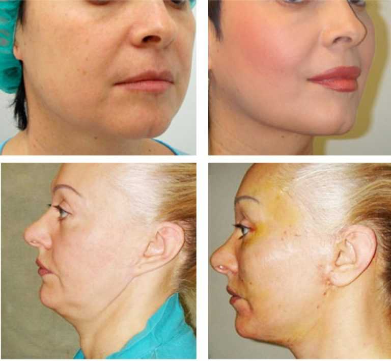Круговая подтяжка лица (фейслифтинг) - хирургическая методика удаления лишней кожи и жировой клетчатки