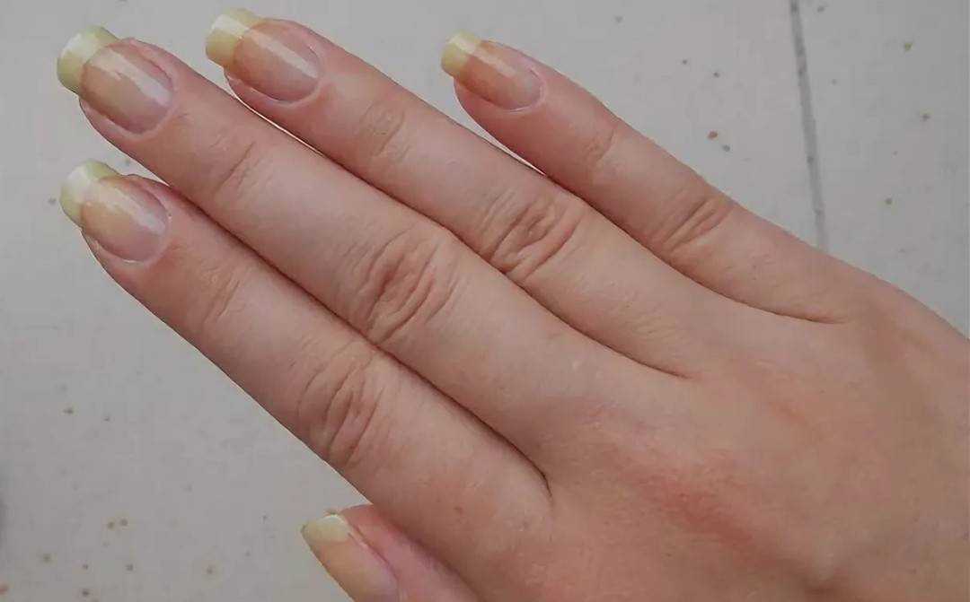 Желтые ногти выглядят болезненно и неопрятно Выясняем, почему ногти желтеют и как можно справиться с этой проблемой в домашних условиях
