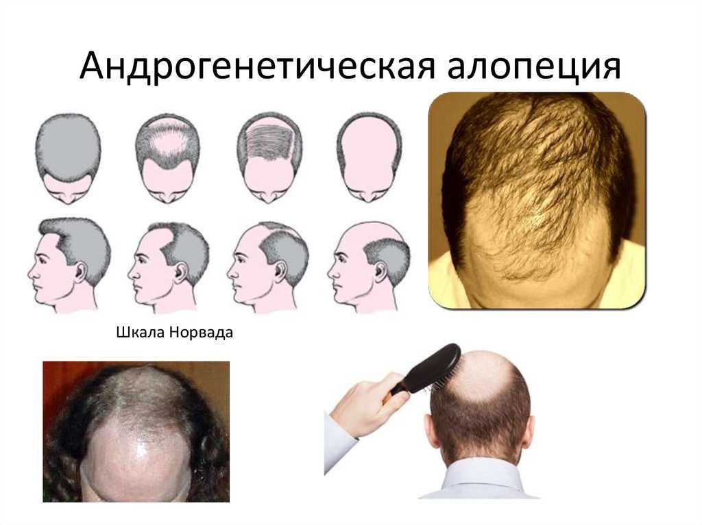 15 причин выпадения волос у мужчин