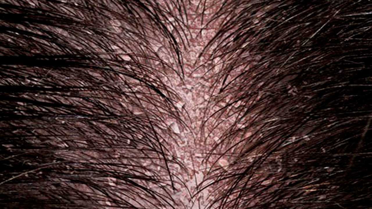 Маска от перхоти в домашних условиях: как правильно подобрать к своему типу волос