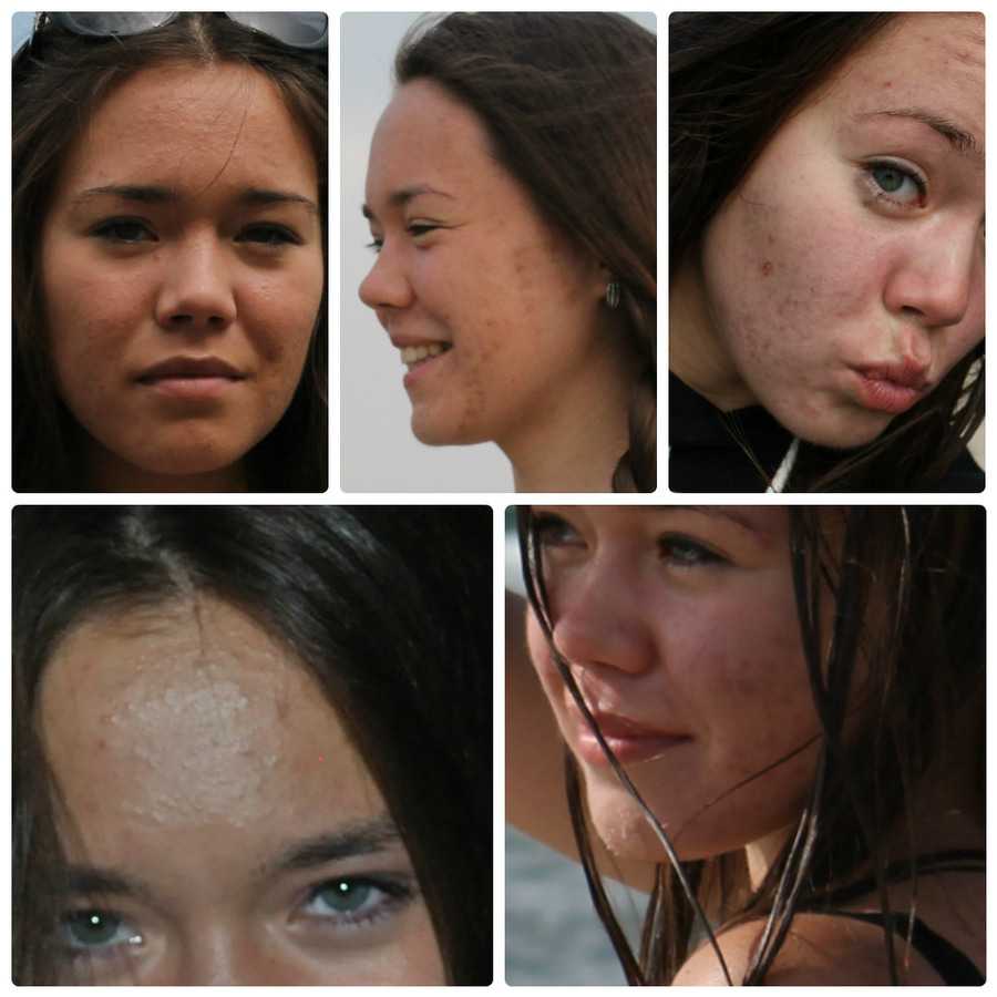 Лицо стало. Девушка с проблемной кожей. Проблемная кожа до и после. Сальность кожи лица.