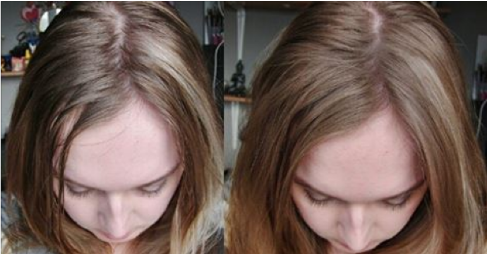 Чистый лоб. Сухой шампунь до и после. Сухой шампунь для волос до и после. Жирные волосы. Грязные волосы до и после.