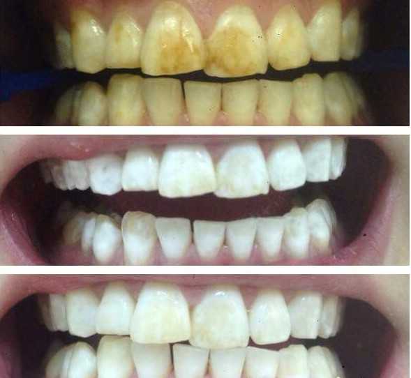 Зубная крепость: как пасты делают наши зубы лучше?